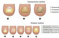 Wavy nails: causes, treatment